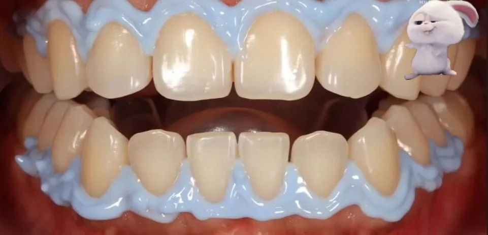 Blanqueamiento dental, antes