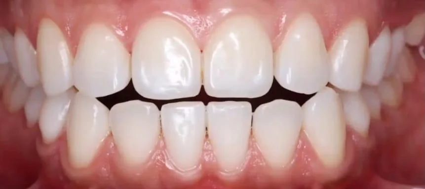 Blanqueamiento dental, después