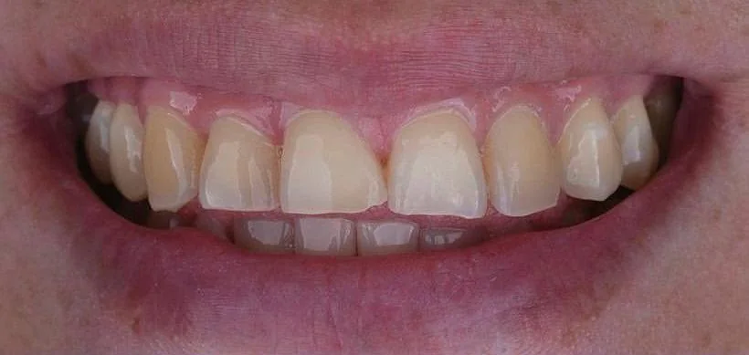 Carillas dentales, antes
