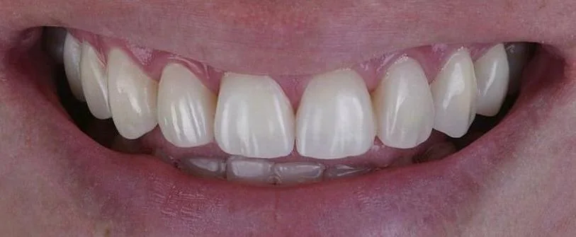 Carillas dentales, después