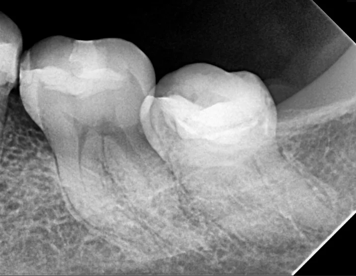 Endodoncia, antes