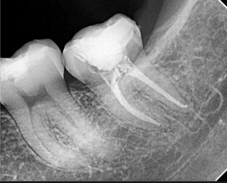 Endodoncia, después