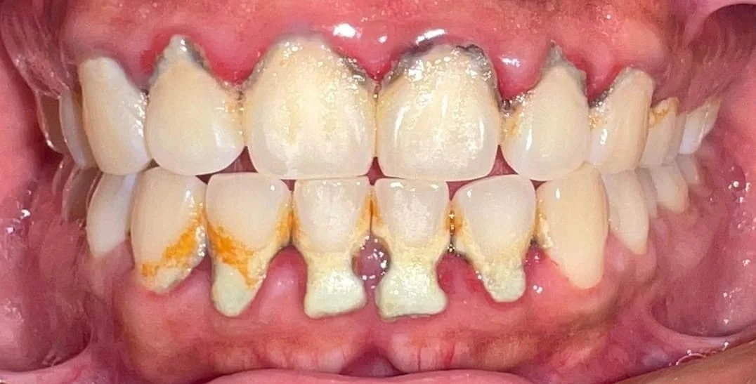 Limpieza dental, antes