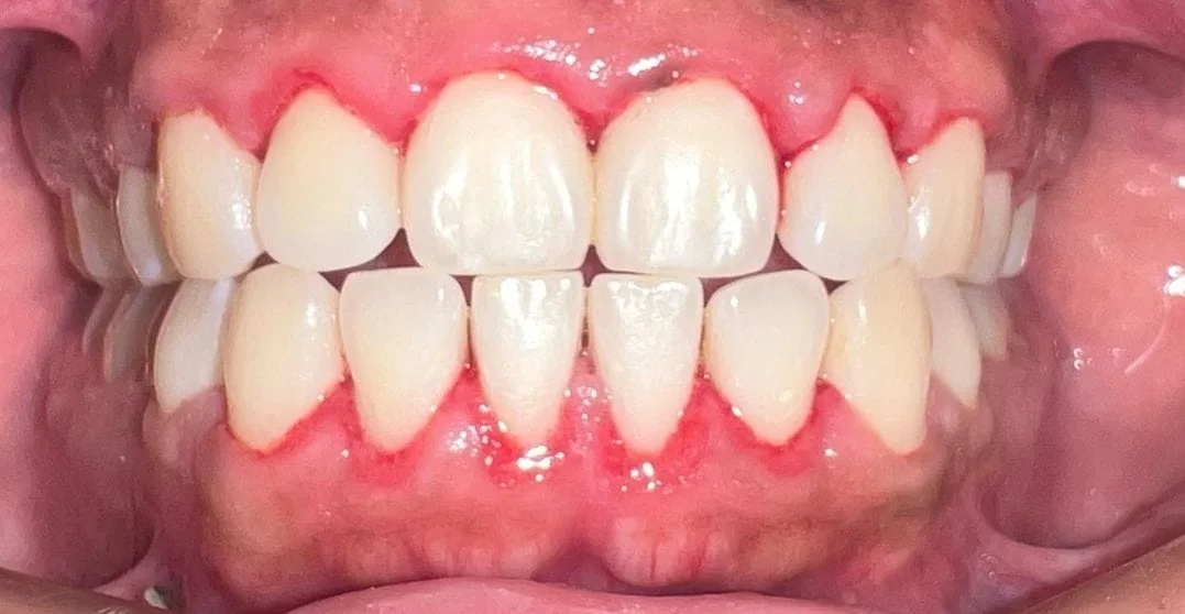 Limpieza dental, después